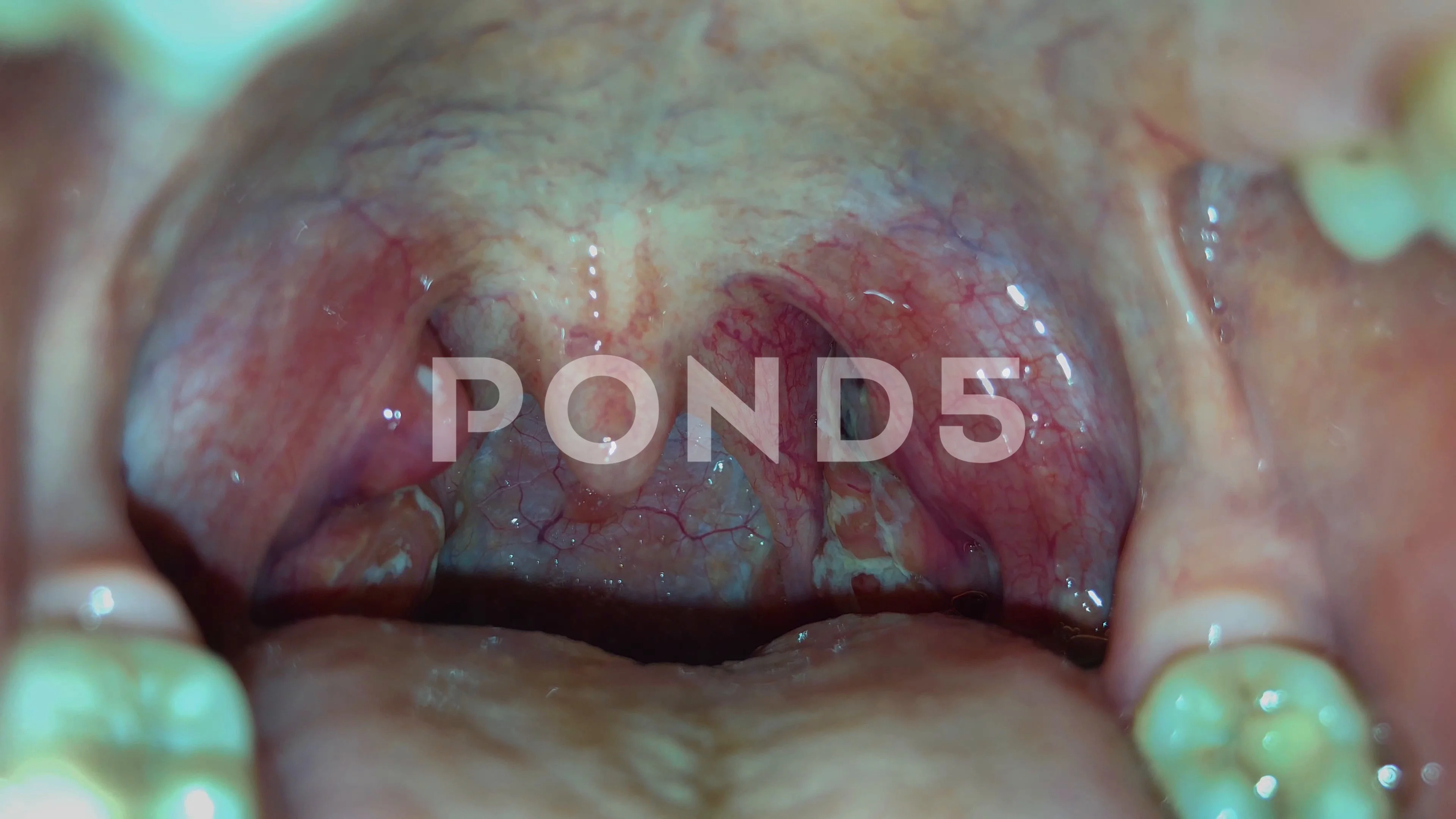 How to treat purulent quinsy in a child How to treat purulent quinsy in a child