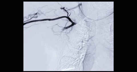 Angiogram of bracial artery Stock Footage 206981538