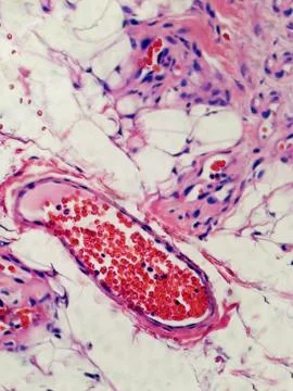 Angiolipoma Stock Photos