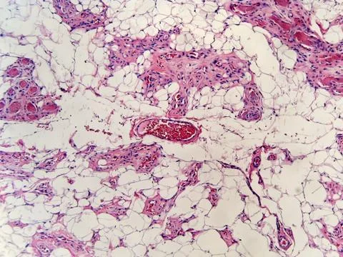 Angiolipoma Stock Photos