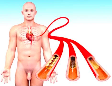 Angioplasty, artwork Stock Illustration