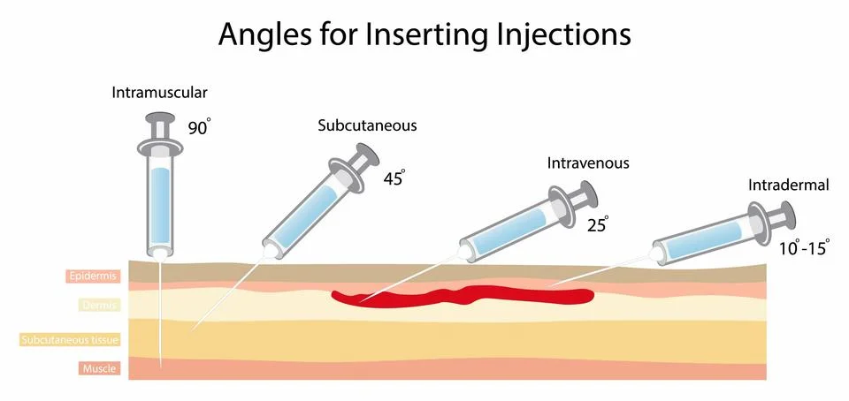 Angles for inserting injections, injection sites Stock Illustration