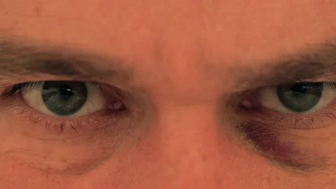 Angry man's eyes close-up. Bruised eye. Violence or abuse concept Stock Footage 239193194