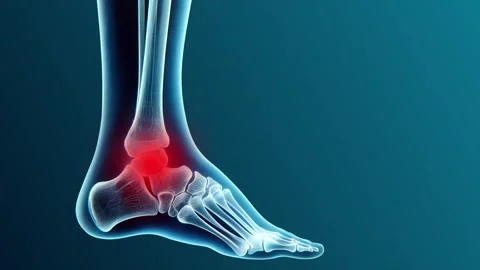 Animated Arthritis in Ankle Visualization Stock Footage 317142964