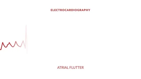 Animated atrial flutter. animated ekg display Stock Footage 285098420
