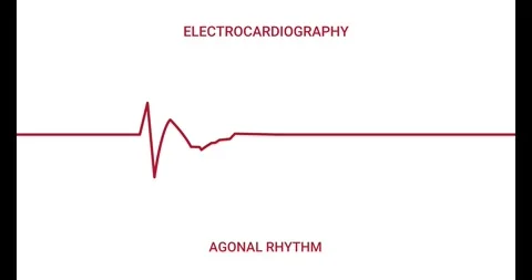 Animated EKG Display. Animated Agonal Rhythm Stock Footage 285098407