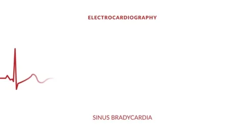 Animated graph showing the sinus bradycardia rhythm. electrocardiograph mon.. Stock Footage 285098446