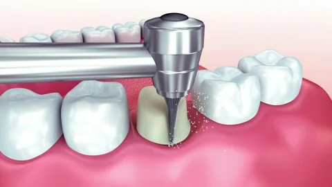 Animated Jawbone and Teeth Alignment Correction Stock Footage 327665048