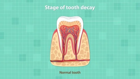 Animated Progression of Tooth Decay Stag... | Stock Video | Pond5
