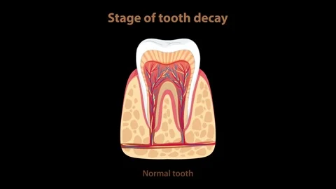 Animated stages of tooth decay process dental health and oral hygiene educa.. Stock Footage 332686220