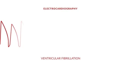 animated ventricular fibrillation. anima... | Stock Video | Pond5