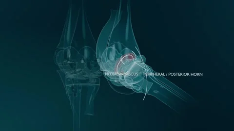 Animating 3D knee joint, drawing guide arc, rotating and labeling medial Stock Footage 344173742