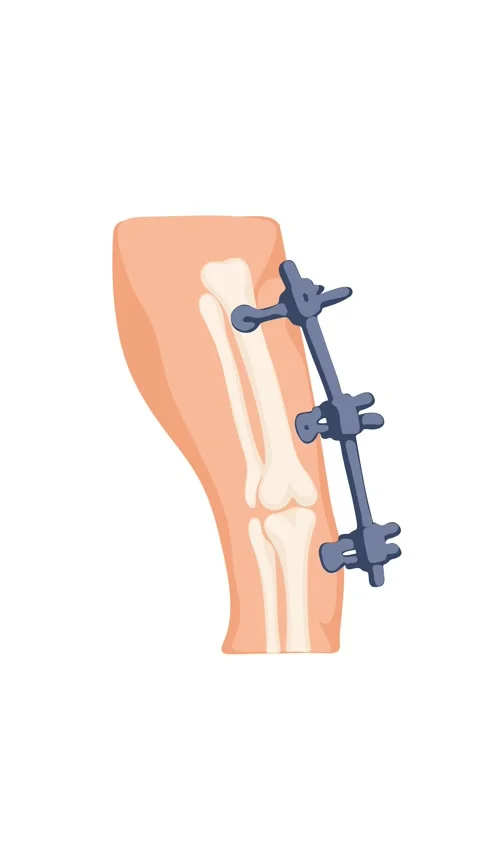 Animation bone fixation pins in leg for fracture healing Stock Footage 345582244