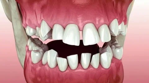 Animation of Broken Tooth with Cavity and Gum Inflammation Stock Footage 327665140