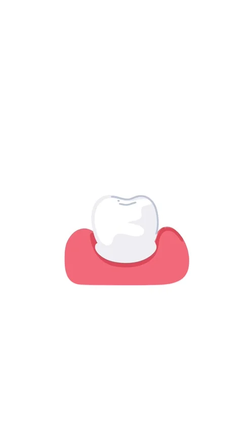 Animation ceramic tooth crown restoration treatment process Stock Footage 336650565