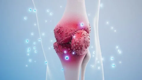 Animation demonstration of knee joint inflammation Stock Footage 314247720