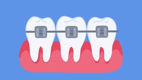 Animation dental braces treatment process Stock Footage 335882683