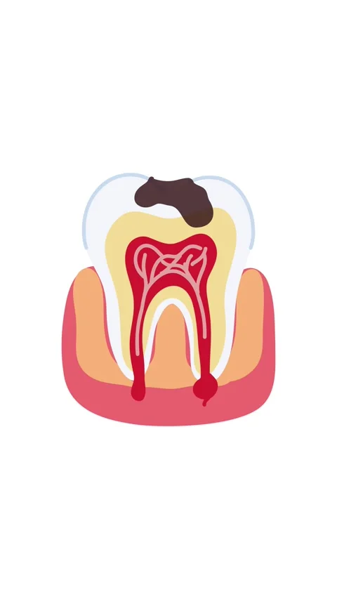 Animation dental cavity formation inside human tooth Stock Footage 336650544