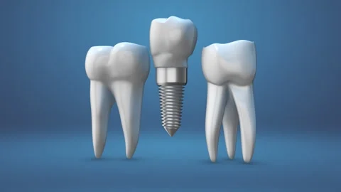 Animation of the dental implants Vídeos de archivo 252129115