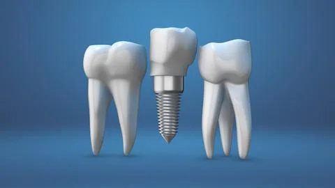 Animation of the dental implants Stock Illustration