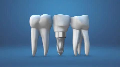 Animation of the dental implants Stock Illustration
