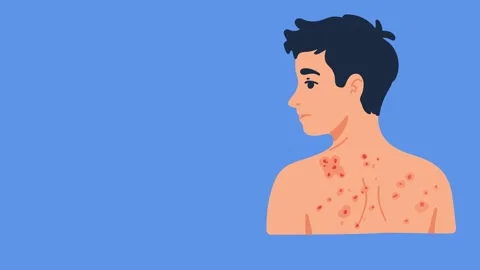 Animation dermatological irritation on man back Stock Footage 335701769