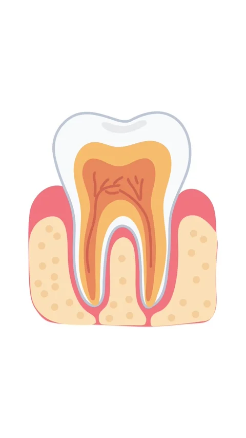 Animation endodontic infection progression in tooth canal Stock Footage 336650560