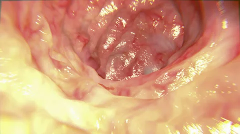Animation of an endoscope view of the intestine affected by Crohn's disease. Stock Footage 36107997