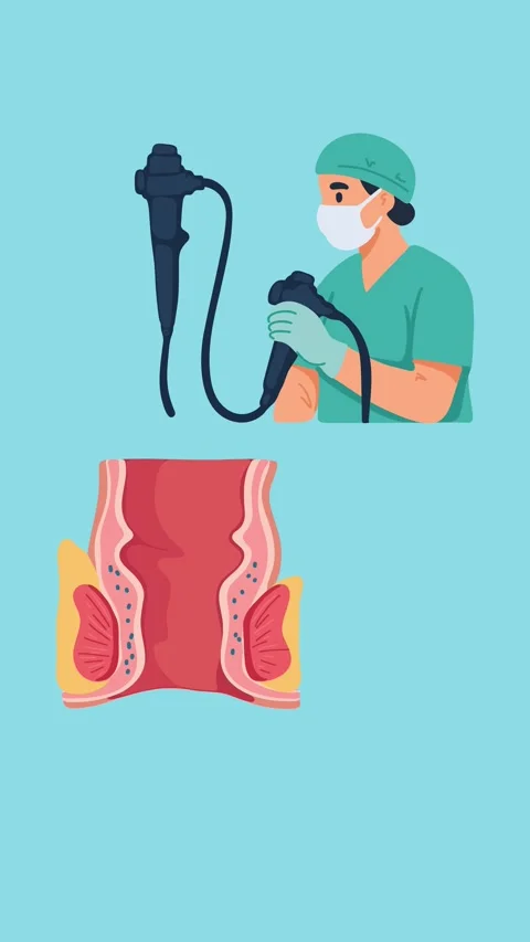 Animation of endoscopic examination of the rectum and hemorrhoids Stock Footage 340956101