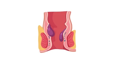Animation of external hemorrhoids anatomy cross section Stock Footage 340879080