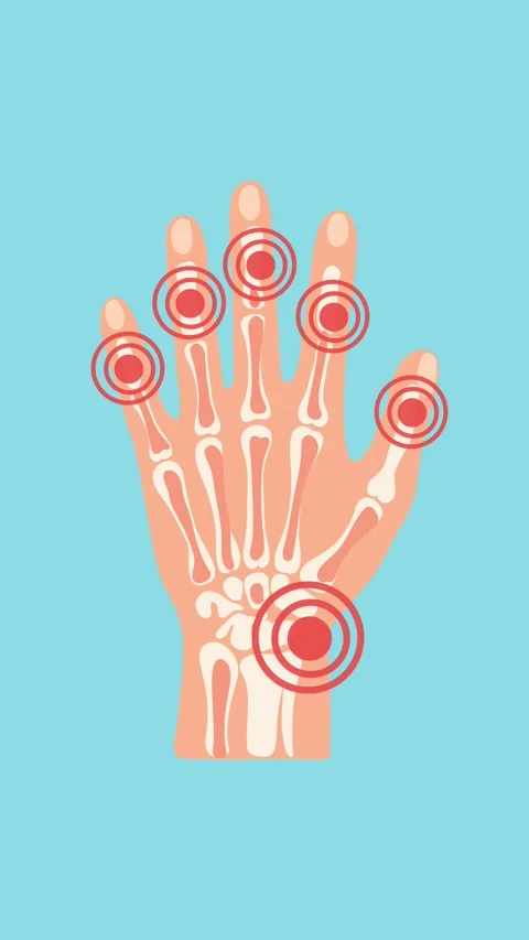 Animation of hand joint inflammation with pain zones Stock Footage 340956210