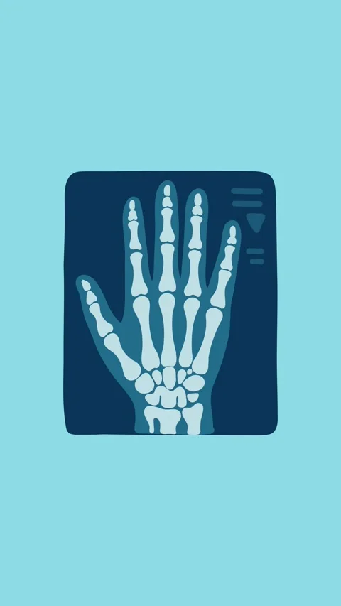 Animation hand x ray for orthopedic diagnosis Stock Footage 340956178