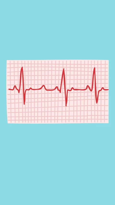 Animation of heart rhythm graph on electrocardiogram Stock Footage 340956412