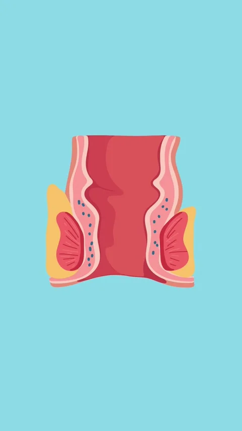 Animation of hemorrhoids and rectal inflammation medical illustration Stock Footage 340956121