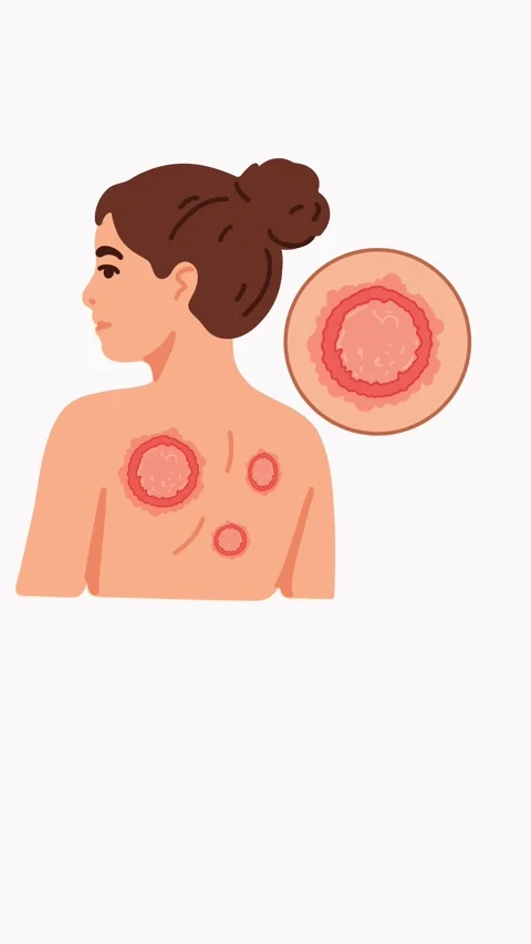 Animation increasing ring shaped lichen lesions on female back 動画素材 335701781