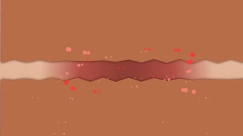 Animation Of Keloid Scar Formation With Excessive Collagen Production Stock Footage 340604200