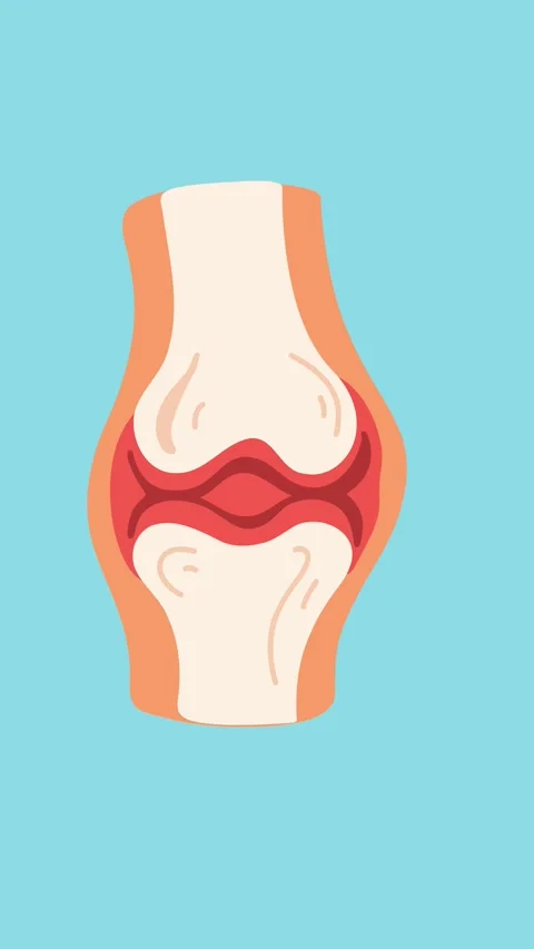 Animation of knee joint inflammation human medical anatomy Stock Footage 340956209