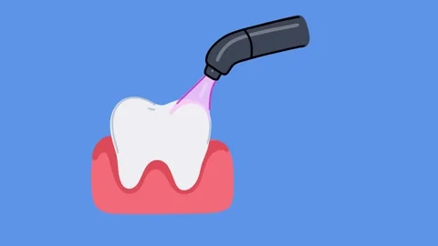 Animation light curing composite filling hardening process in tooth Stock Footage 336650550