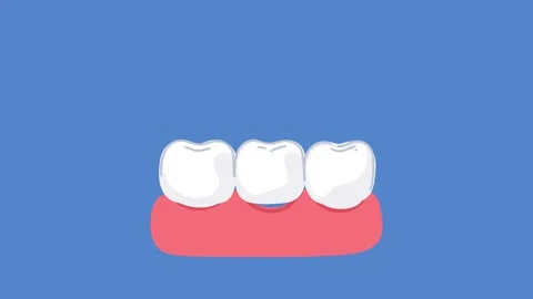 Animation modern dental crown fitting and installation Stock Footage 336650555