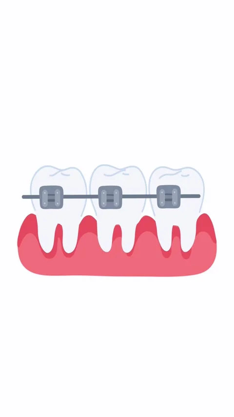 Animation orthodontic brackets installation 動画素材 335882679