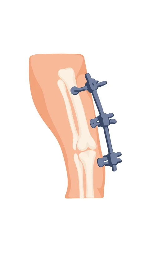 Animation orthopedic pins stabilizing broken leg bone during healing Stock Footage 345582245