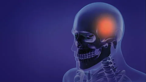 Animation of a painful Headache 動画素材 168439520