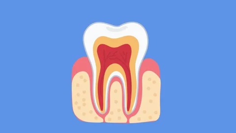 Animation root canal inflammation inside human tooth 動画素材 336650542