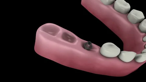 Animation showing the installation process of a dental bridge in the mouth. Stock-Footage 265642575