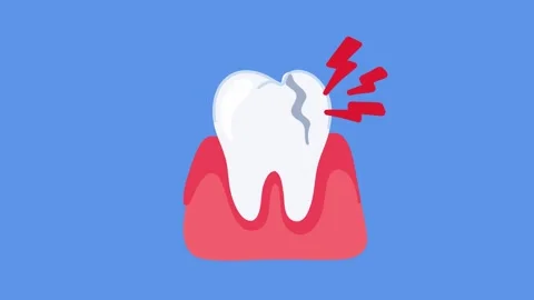 Animation showing tooth with visible crack damage Stock Footage 336298588