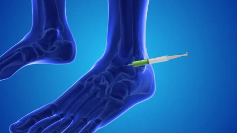 An animation shows stem cells being injected into a human feet Stock Footage 251857305