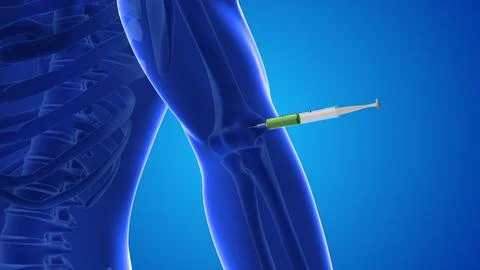An animation shows stem cells being injected into a human elbow joint Stock Illustration