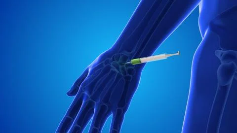 An animation shows stem cells being injected into a wrist Stock Illustration