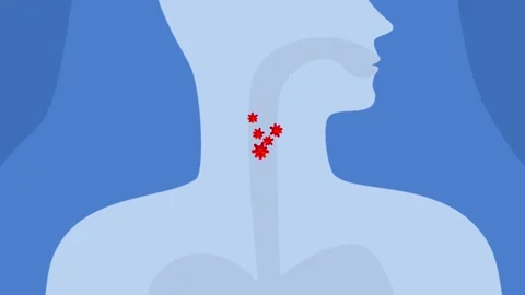 Animation sore throat or bacteria in throat .Illness or cold or flu virus Stock Footage 244449281