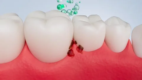 Animation of tooth cleaning process 库存影片 318940356